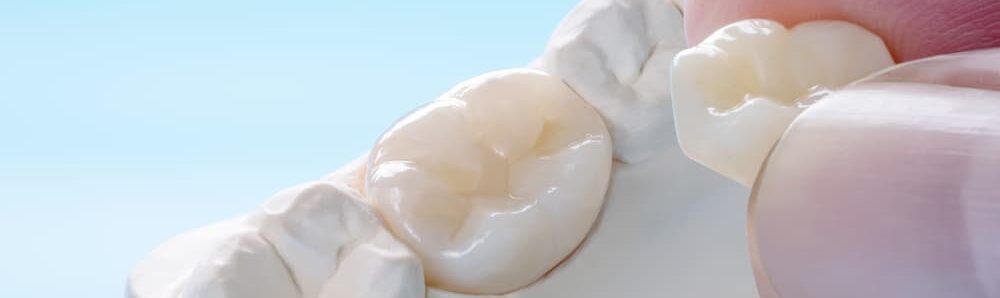 Close-up of a dentist placing a porcelain dental crown, highlighting dental crowns in Waller, TX.